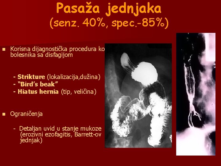 Pasaža jednjaka (senz. 40%, spec. -85%) n Korisna dijagnostička procedura kod bolesnika sa disfagijom Pasaža jednjaka (senz. 40%, spec. -85%) n Korisna dijagnostička procedura kod bolesnika sa disfagijom