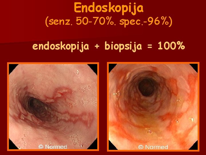Endoskopija (senz. 50 -70%. spec. -96%) endoskopija + biopsija = 100% Endoskopija (senz. 50 -70%. spec. -96%) endoskopija + biopsija = 100%