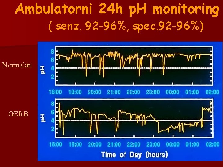 Ambulatorni 24 h p. H monitoring ( senz. 92 -96%, spec. 92 -96%) Normalan Ambulatorni 24 h p. H monitoring ( senz. 92 -96%, spec. 92 -96%) Normalan