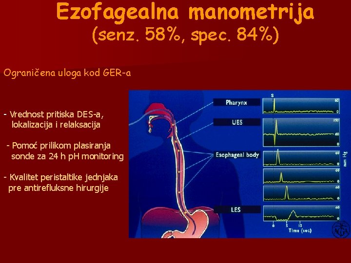 Ezofagealna manometrija (senz. 58%, spec. 84%) Ograničena uloga kod GER-a - Vrednost pritiska DES-a, Ezofagealna manometrija (senz. 58%, spec. 84%) Ograničena uloga kod GER-a - Vrednost pritiska DES-a,