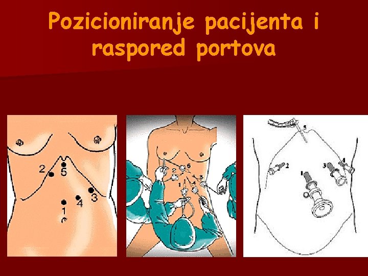 Pozicioniranje pacijenta i raspored portova Pozicioniranje pacijenta i raspored portova