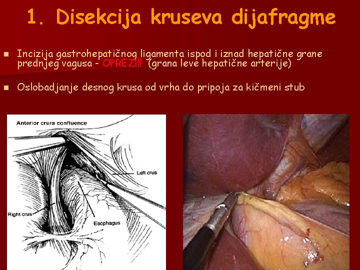 1. Disekcija kruseva dijafragme n Incizija gastrohepatičnog ligamenta ispod i iznad hepatične grane prednjeg 1. Disekcija kruseva dijafragme n Incizija gastrohepatičnog ligamenta ispod i iznad hepatične grane prednjeg