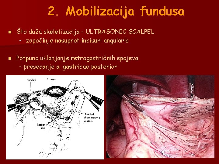 2. Mobilizacija fundusa n Što duža skeletizacija - ULTRASONIC SCALPEL - započinje nasuprot incisuri 2. Mobilizacija fundusa n Što duža skeletizacija - ULTRASONIC SCALPEL - započinje nasuprot incisuri