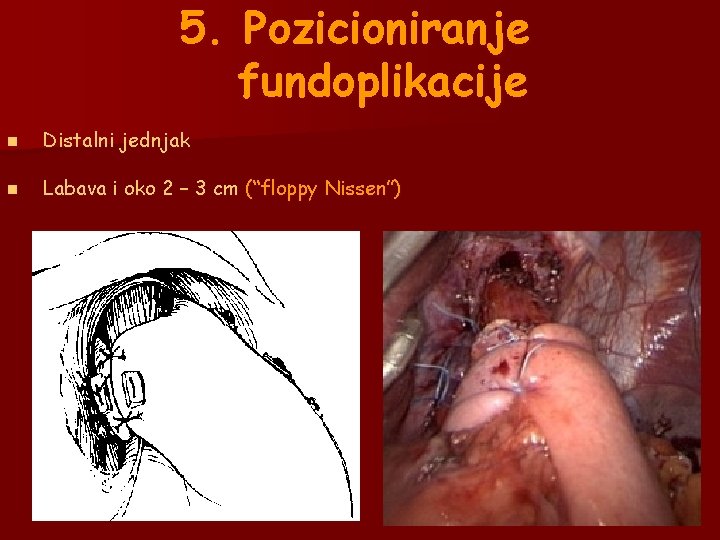 5. Pozicioniranje fundoplikacije n Distalni jednjak n Labava i oko 2 – 3 cm 5. Pozicioniranje fundoplikacije n Distalni jednjak n Labava i oko 2 – 3 cm
