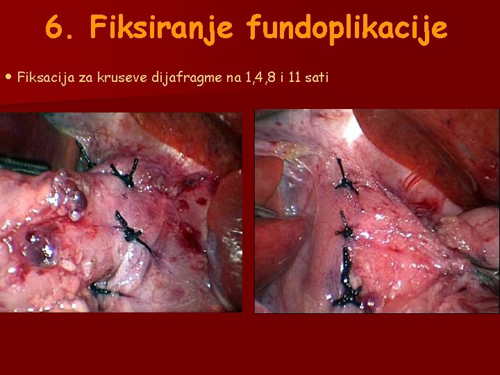 6. Fiksiranje fundoplikacije • Fiksacija za kruseve dijafragme na 1, 4, 8 i 11 6. Fiksiranje fundoplikacije • Fiksacija za kruseve dijafragme na 1, 4, 8 i 11