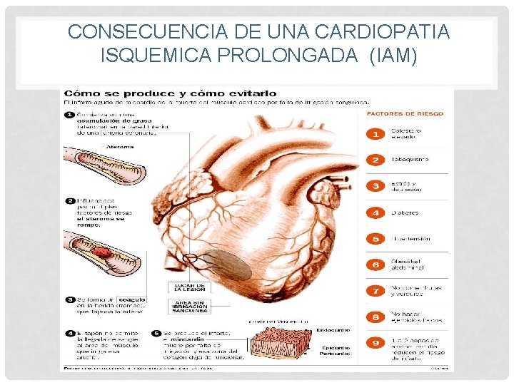 CONSECUENCIA DE UNA CARDIOPATIA ISQUEMICA PROLONGADA (IAM) 