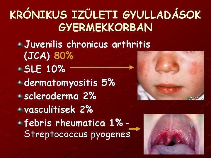 KRÓNIKUS IZÜLETI GYULLADÁSOK GYERMEKKORBAN Juvenilis chronicus arthritis (JCA) 80% SLE 10% dermatomyositis 5% scleroderma