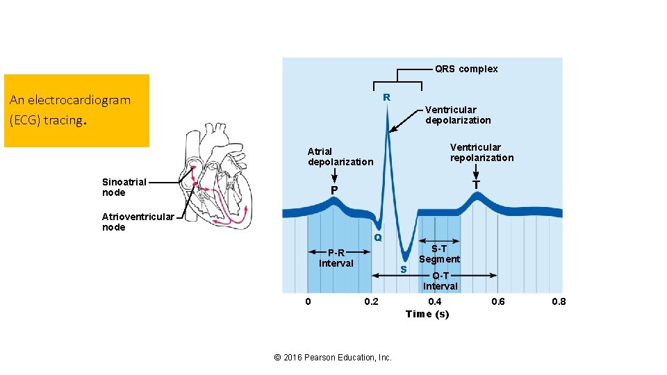 QRS complex R An electrocardiogram (ECG) tracing. Ventricular depolarization Ventricular repolarization Atrial depolarization Sinoatrial