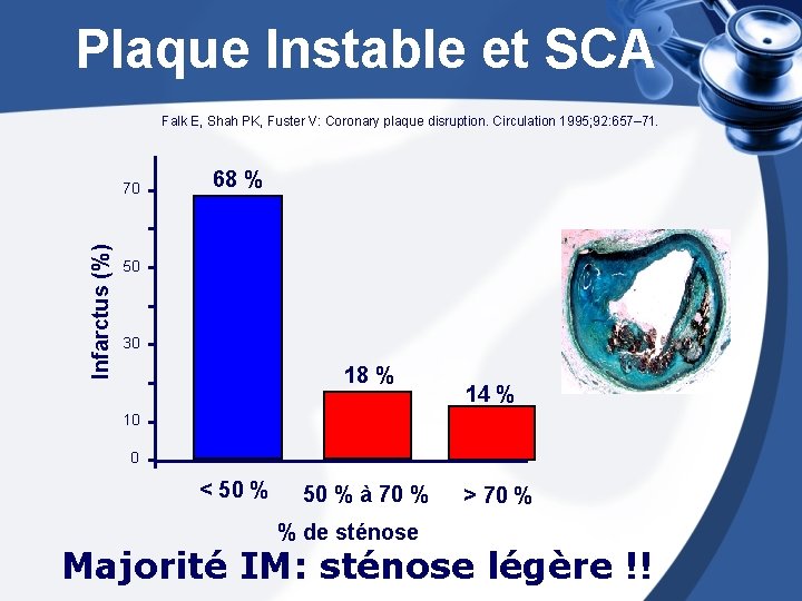 Plaque Instable et SCA Falk E, Shah PK, Fuster V: Coronary plaque disruption. Circulation