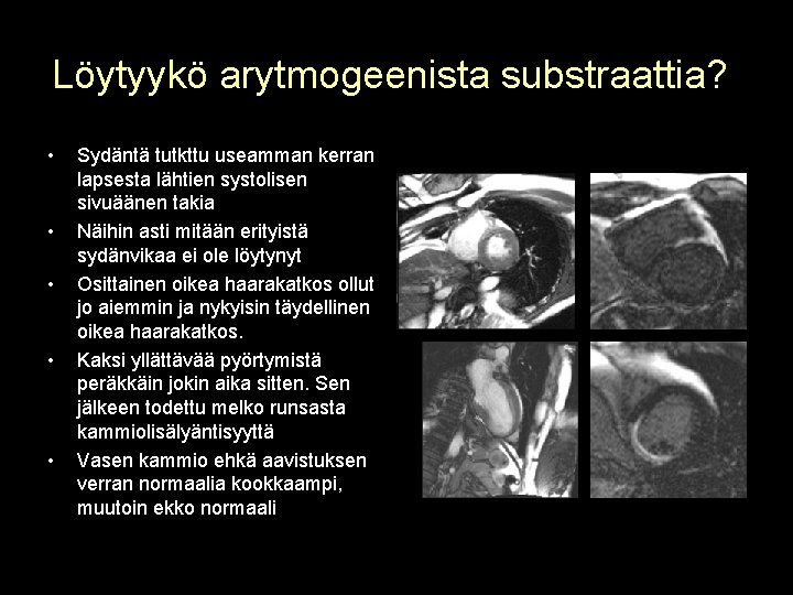 Löytyykö arytmogeenista substraattia? • • • Sydäntä tutkttu useamman kerran lapsesta lähtien systolisen sivuäänen