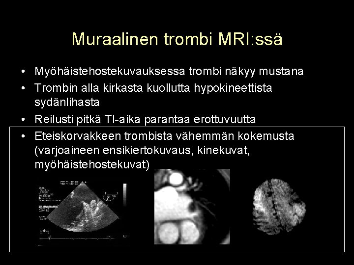 Muraalinen trombi MRI: ssä • Myöhäistehostekuvauksessa trombi näkyy mustana • Trombin alla kirkasta kuollutta