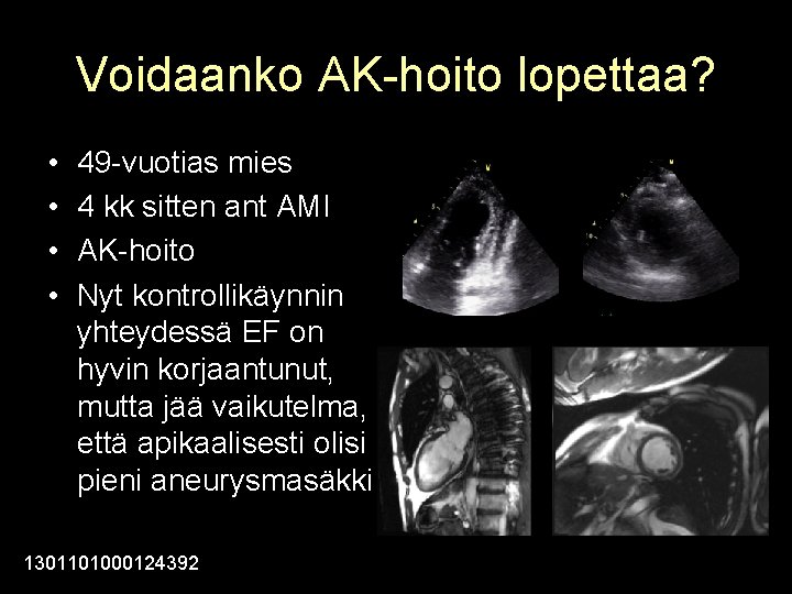 Voidaanko AK-hoito lopettaa? • • 49 -vuotias mies 4 kk sitten ant AMI AK-hoito