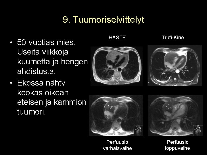 9. Tuumoriselvittelyt • 50 -vuotias mies. Useita viikkoja kuumetta ja hengen ahdistusta. • Ekossa