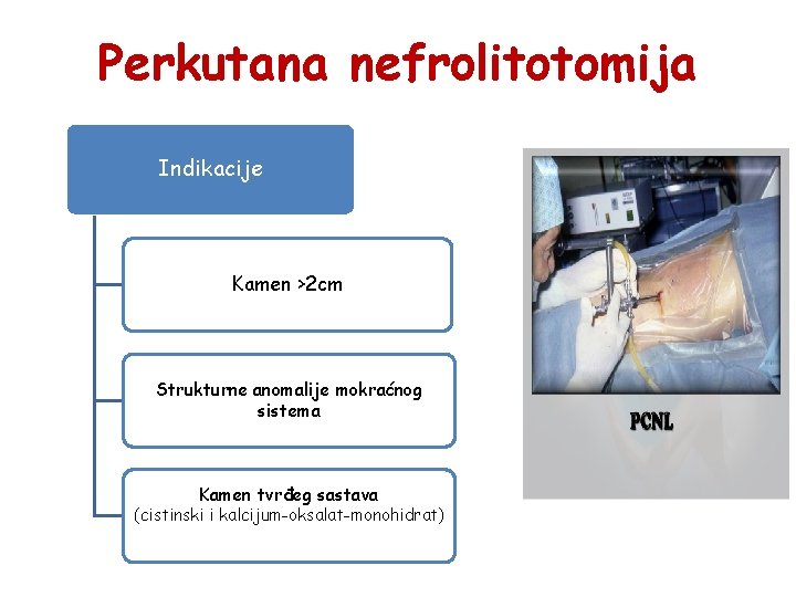 Perkutana nefrolitotomija Indikacije Kamen >2 cm Strukturne anomalije mokraćnog sistema Kamen tvrđeg sastava (cistinski