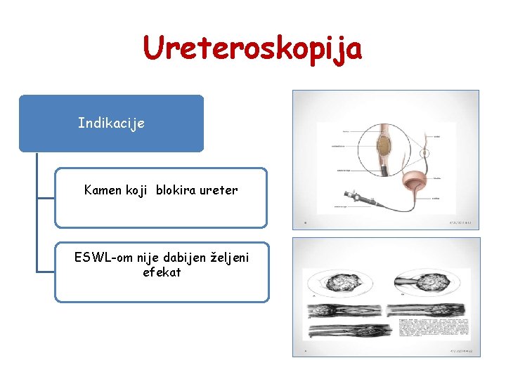 Ureteroskopija Indikacije Kamen koji blokira ureter ESWL-om nije dabijen željeni efekat 