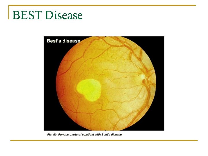 BEST Disease 