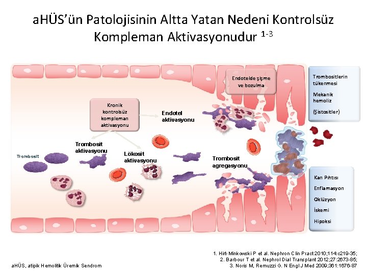 a. HÜS’ün Patolojisinin Altta Yatan Nedeni Kontrolsüz Kompleman Aktivasyonudur 1 -3 Endotelde şişme ve