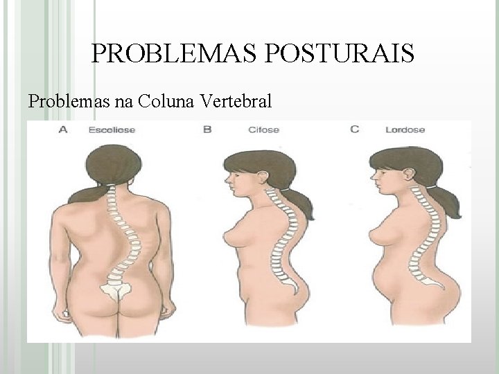 PROBLEMAS POSTURAIS Problemas na Coluna Vertebral 