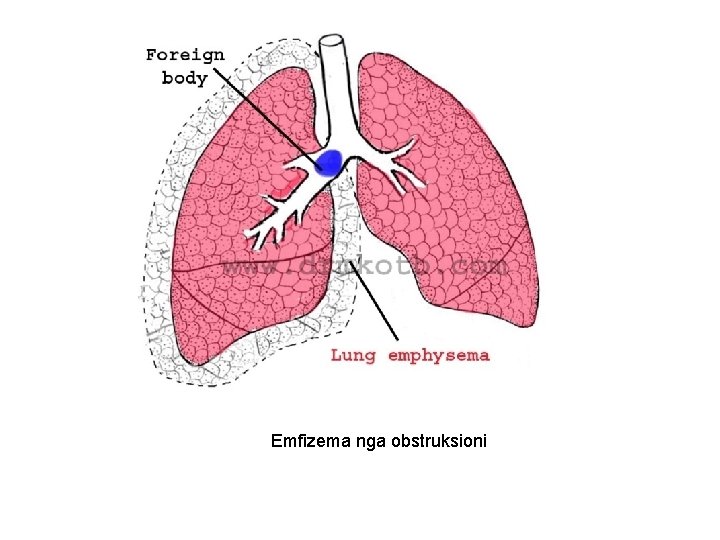 Emfizema nga obstruksioni 