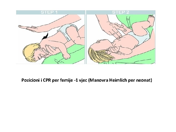 Pozicioni i CPR per femije -1 vjec (Manovra Heimlich per neonat) 