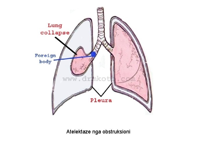 Atelektaze nga obstruksioni 