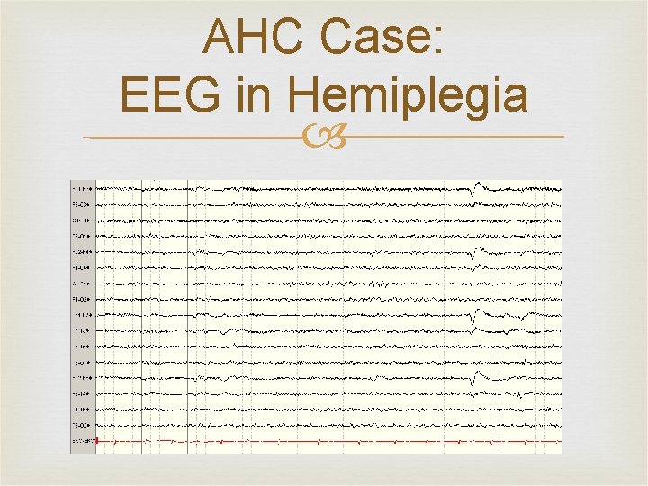 AHC Case: EEG in Hemiplegia 