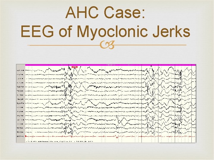 AHC Case: EEG of Myoclonic Jerks 