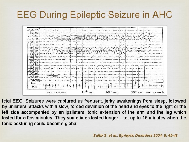 EEG During Epileptic Seizure in AHC Ictal EEG. Seizures were captured as frequent, jerky