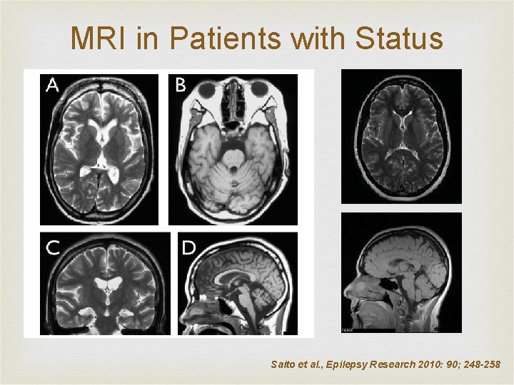 MRI in Patients with Status Saito et al. , Epilepsy Research 2010: 90; 248