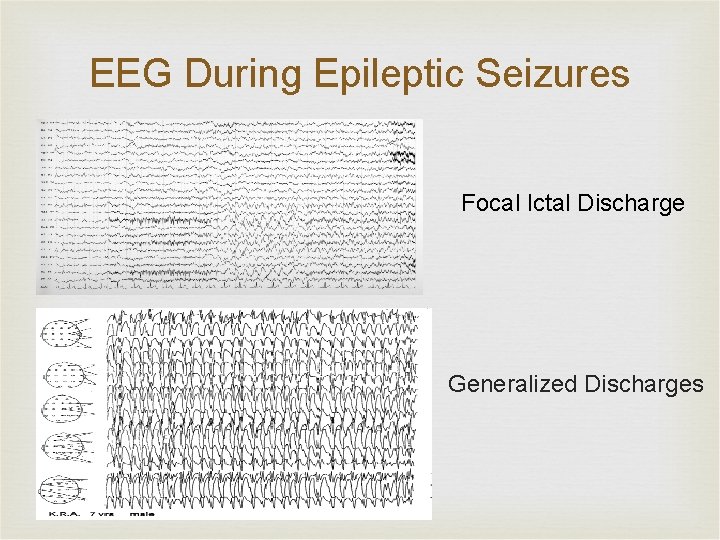 EEG During Epileptic Seizures Focal Ictal Discharge Generalized Discharges 