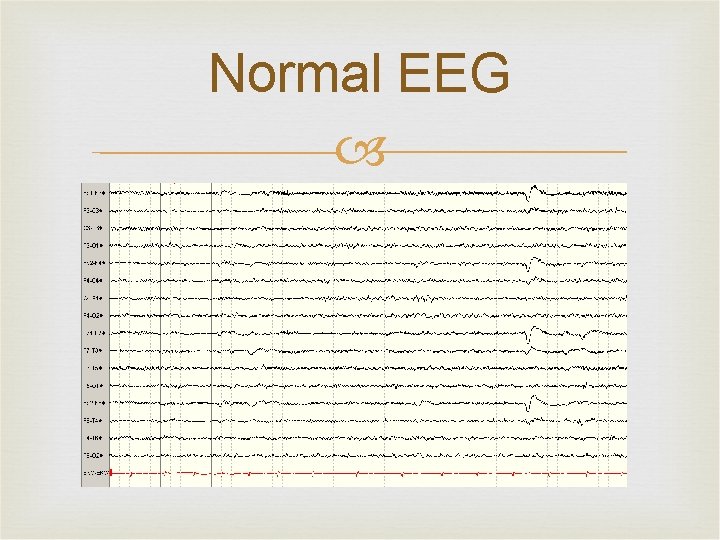 Normal EEG 