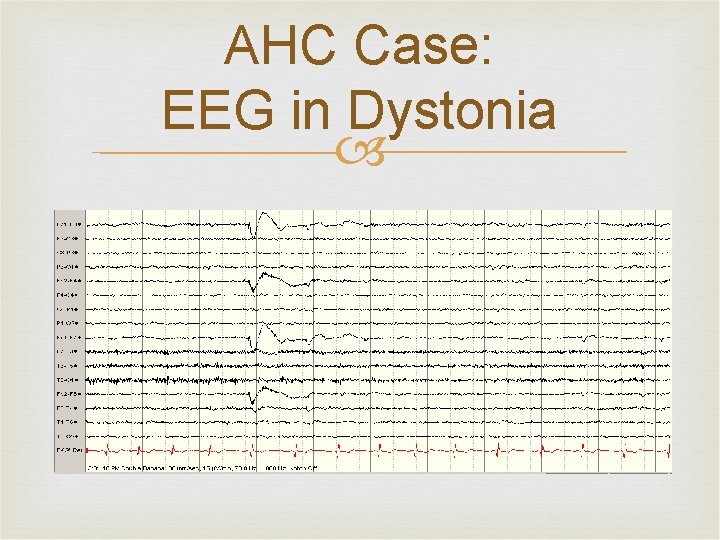 AHC Case: EEG in Dystonia 