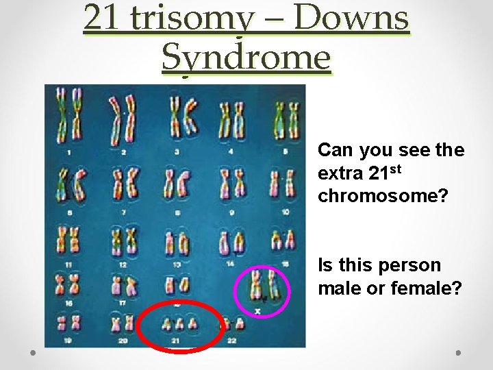 21 trisomy – Downs Syndrome Can you see the extra 21 st chromosome? Is 21 trisomy – Downs Syndrome Can you see the extra 21 st chromosome? Is