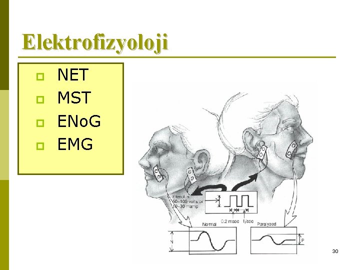 Elektrofizyoloji p p NET MST ENo. G EMG 30 