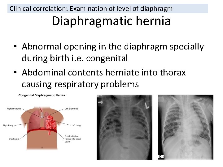 Clinical correlation: Examination of level of diaphragm Diaphragmatic hernia • Abnormal opening in the Clinical correlation: Examination of level of diaphragm Diaphragmatic hernia • Abnormal opening in the