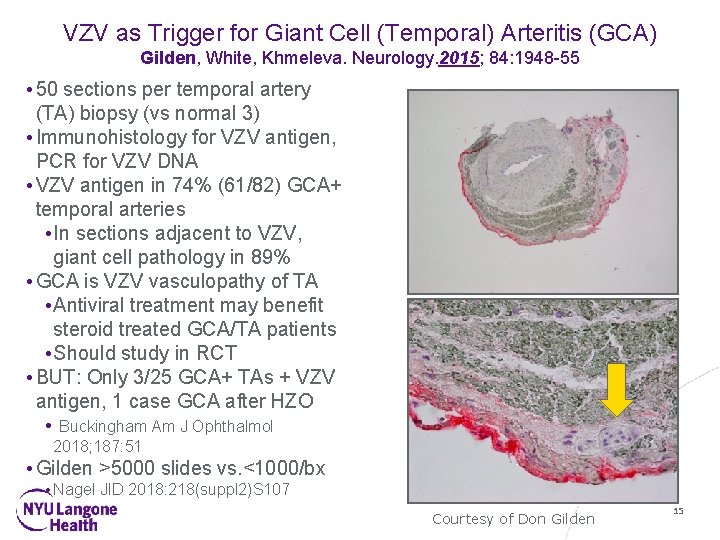 VZV as Trigger for Giant Cell (Temporal) Arteritis (GCA) Gilden, White, Khmeleva. Neurology. 2015;