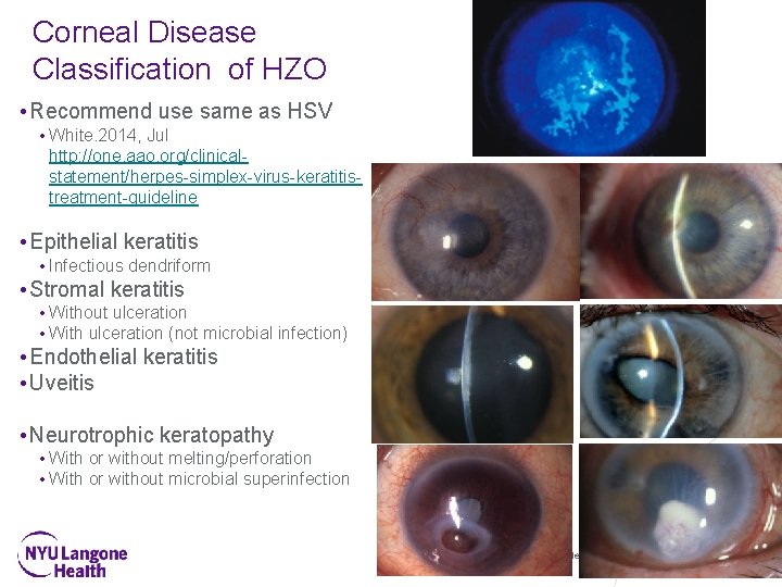 Corneal Disease Classification of HZO • Recommend use same as HSV • White. 2014,