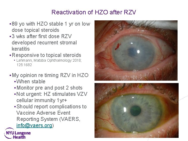 Reactivation of HZO after RZV • 89 yo with HZO stable 1 yr on