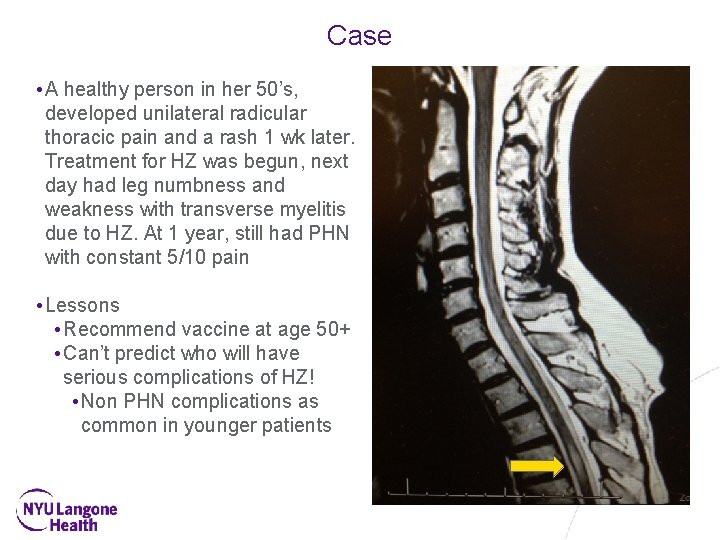 Case • A healthy person in her 50’s, developed unilateral radicular thoracic pain and