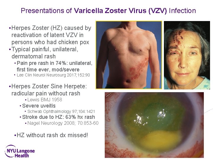 Presentations of Varicella Zoster Virus (VZV) Infection • Herpes Zoster (HZ) caused by reactivation