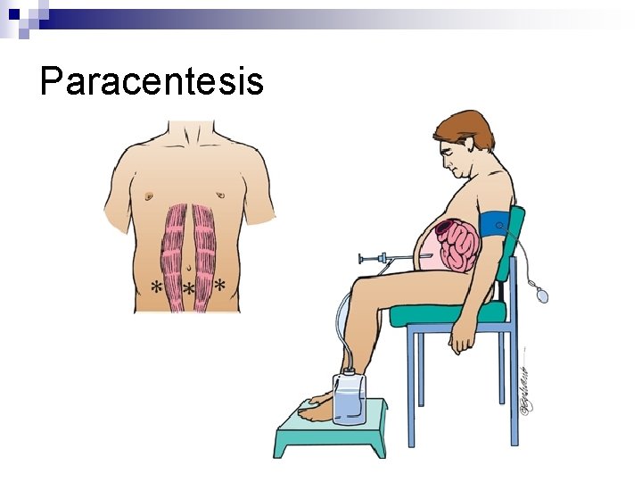 Paracentesis 