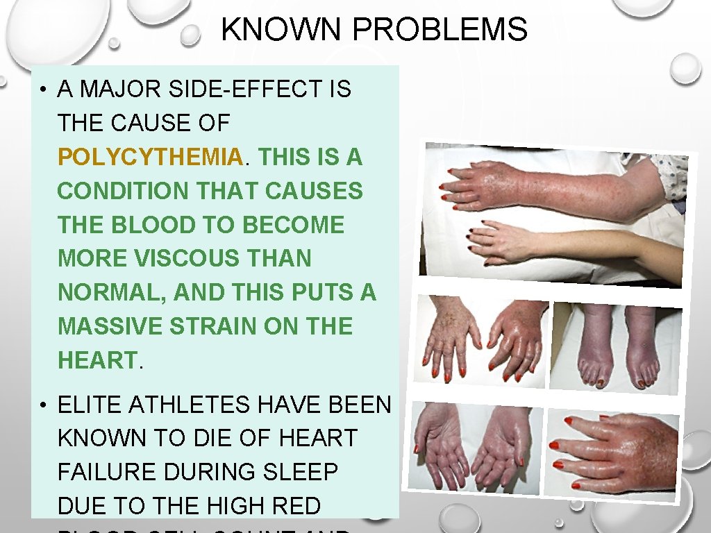 KNOWN PROBLEMS • A MAJOR SIDE-EFFECT IS THE CAUSE OF POLYCYTHEMIA. THIS IS A