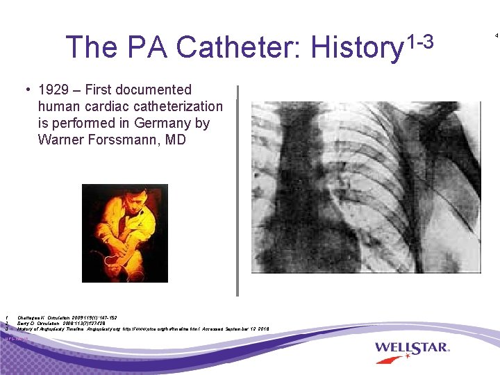 The PA Catheter: History 1 -3 • 1929 – First documented human cardiac catheterization