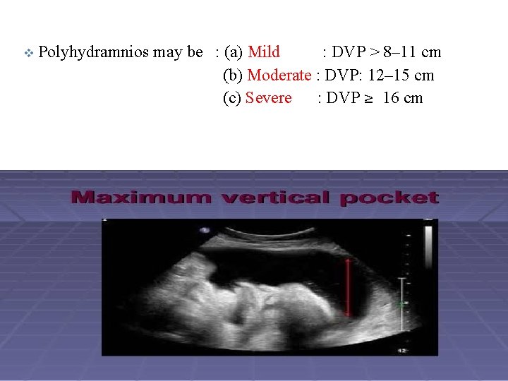 v Polyhydramnios may be : (a) Mild : DVP > 8– 11 cm (b)