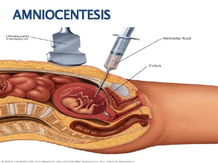 AMNIOCENTESIS 