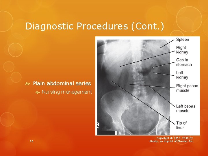 Diagnostic Procedures (Cont. ) Plain abdominal series Nursing management 20 Copyright © 2014, 2010