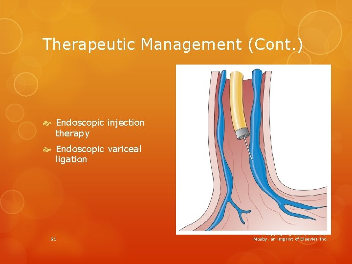Therapeutic Management (Cont. ) Endoscopic injection therapy Endoscopic variceal ligation 61 Copyright © 2014,