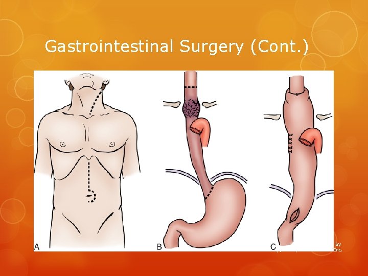 Gastrointestinal Surgery (Cont. ) 64 Copyright © 2014, 2010 by Mosby, an imprint of