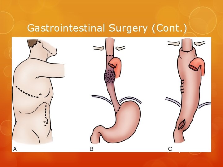 Gastrointestinal Surgery (Cont. ) 65 Copyright © 2014, 2010 by Mosby, an imprint of