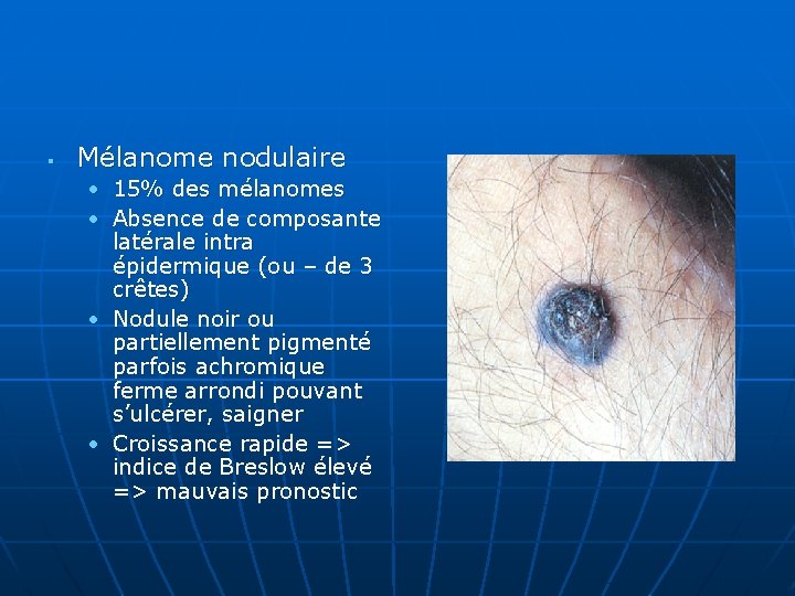 § Mélanome nodulaire • 15% des mélanomes • Absence de composante latérale intra épidermique